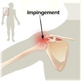 impingement